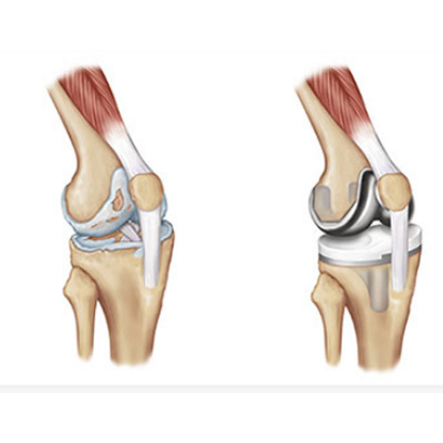 Knee replacement surgery Image